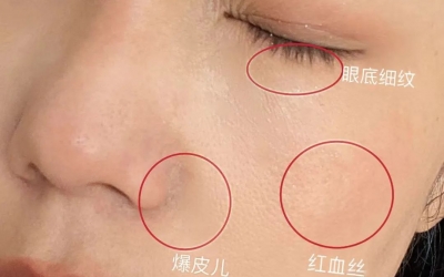 如何判斷自己是不是干敏肌膚？干敏肌有哪些特征？