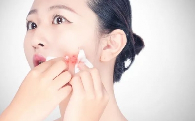 如何預(yù)防粉刺的發(fā)生和痤瘡的形成？
