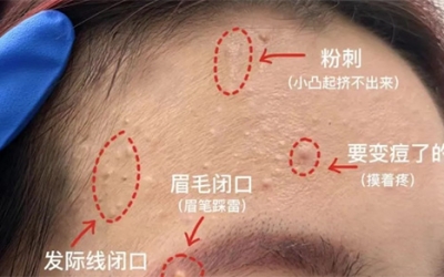 臉上經(jīng)常長閉口粉刺的原因有哪些？